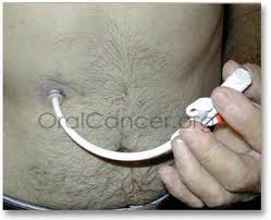 What a feeding tube looks like coming out of guy's body